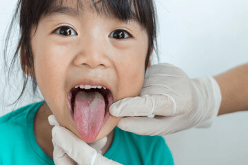 Geographic Tongue