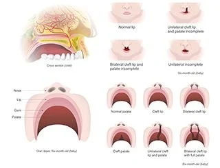 Cleft Lip and Palate