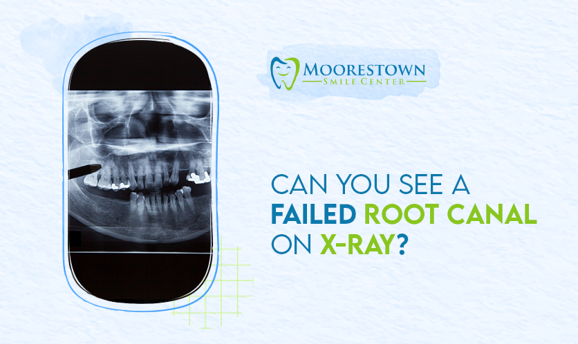 Can You See a Failed Root Canal on X-Ray