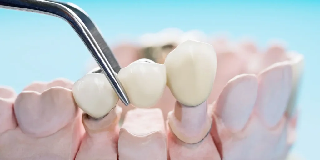Dental Crowns & Bridges Moorestown NJ