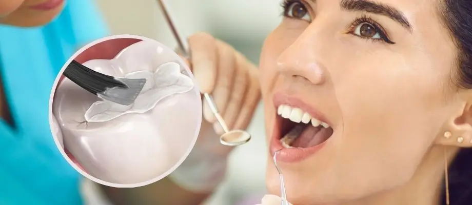 Dental Sealants