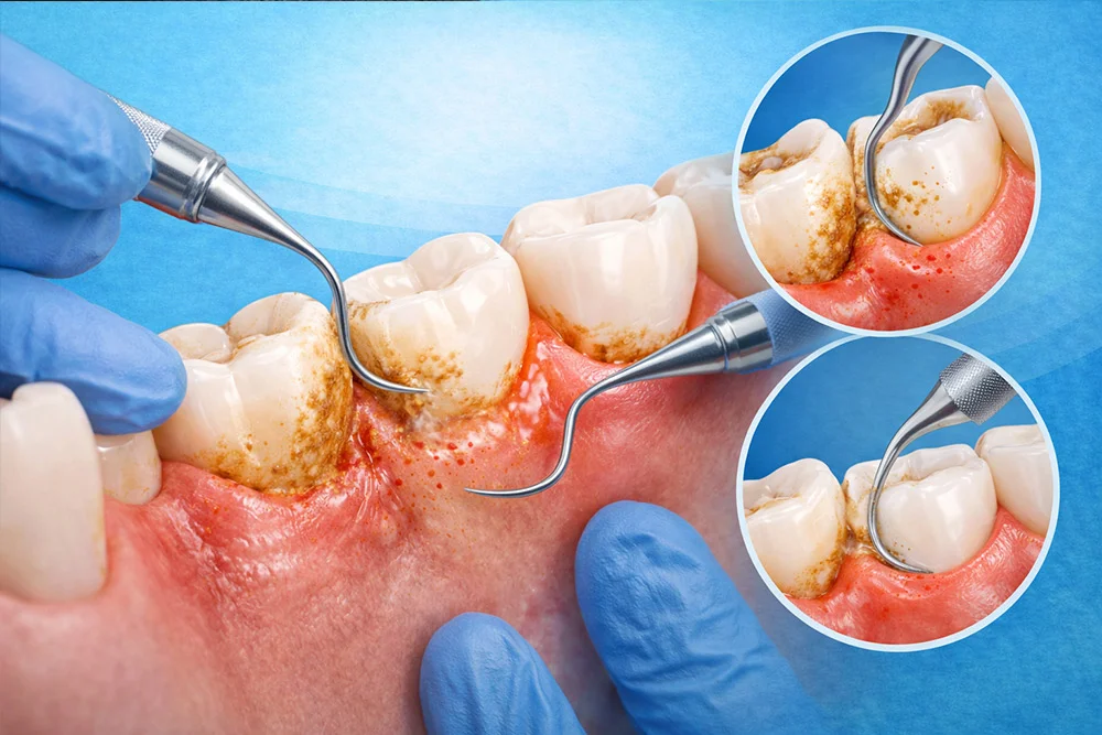 Scaling and root planing is a deep periodontal therapy